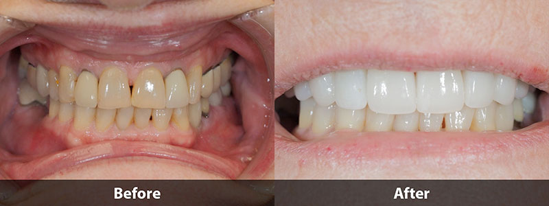 before & after difference of dental treatment
